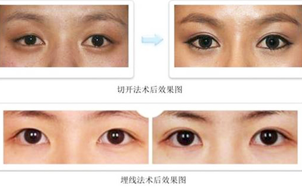 雙眼皮埋線(xiàn)和切開(kāi)哪個(gè)比較好?疼痛程度有什么不同？