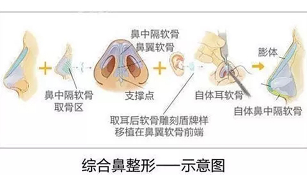 鼻綜合整形的效果怎么樣？鼻綜合手術(shù)安全嗎？