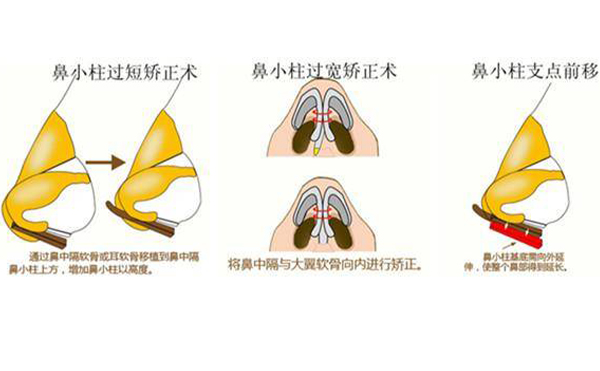 鼻小柱缺損修復(fù)有幾種方法？為什么會(huì)出現(xiàn)鼻小柱缺損的情況