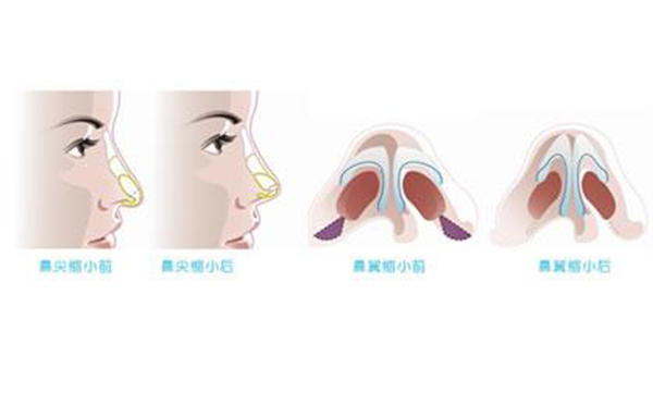 鼻翼縮小整形安全嗎？術(shù)后會(huì)不會(huì)影響呼吸