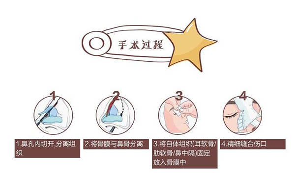 自體軟骨隆鼻為什么這么受歡迎？