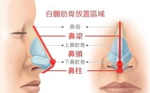 做個(gè)肋骨鼻子一般需要多少錢?全肋好還是半肋好?