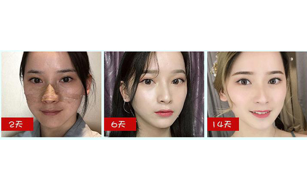 全肋鼻和半肋鼻有什么區(qū)別？做全肋好還是半肋好