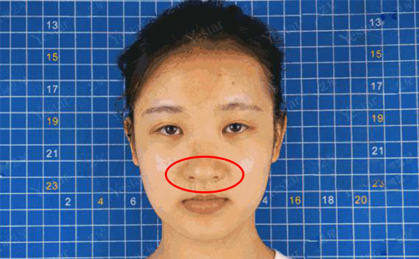 鼻頭肥大是什么原因造成的？怎么解決鼻頭肥大