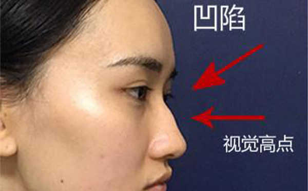 駝峰鼻整形是怎么做的？不同嚴重程度的駝峰鼻矯正方法一樣嗎？
