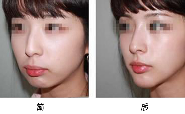 箭鼻是怎么出現(xiàn)的?箭鼻矯正是如何操作的？