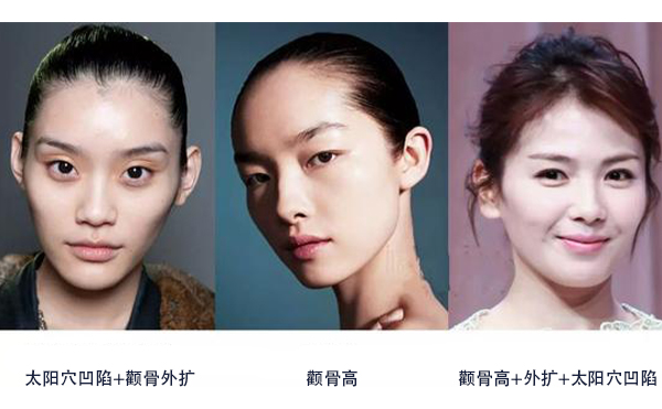 怎么區(qū)分是顴骨高還是太陽(yáng)穴凹陷？