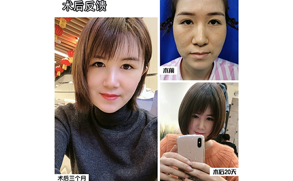 電波拉皮除皺的步驟是什么？