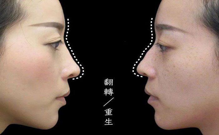 駝峰鼻矯正手術(shù)多少錢？駝峰鼻怎么改善？
