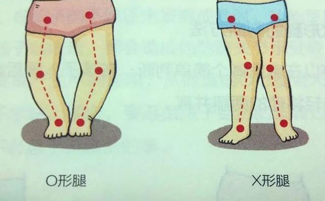 羅圈腿怎樣矯正？羅圈腿手術(shù)矯正多少錢？