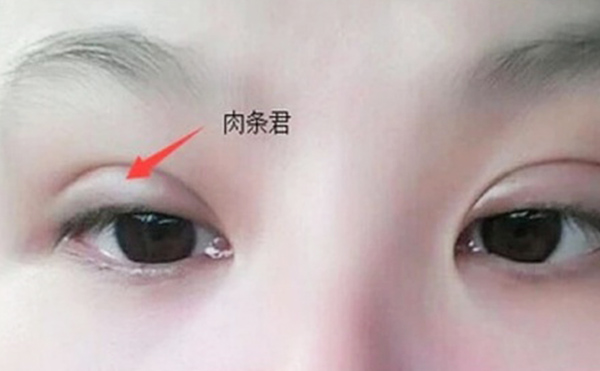 雙眼皮不自然怎么補(bǔ)救？雙眼皮肉條好修復(fù)么？