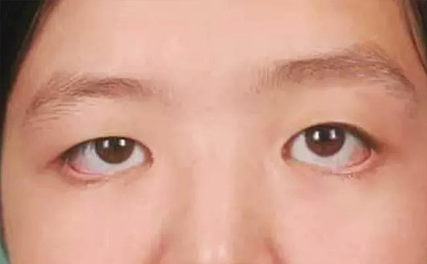 眼袋修復(fù)一般多少錢?眼袋修復(fù)術(shù)后怎么護(hù)理?