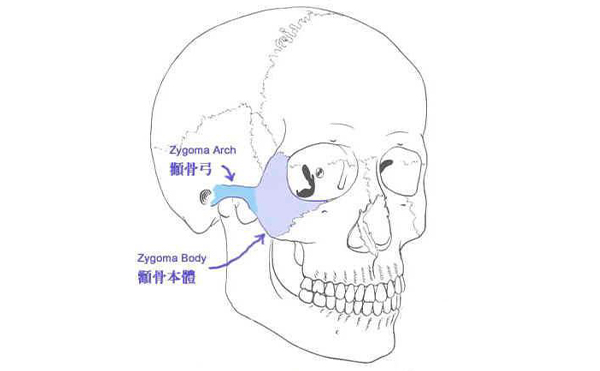 什么樣的臉型需要做顴骨整形？