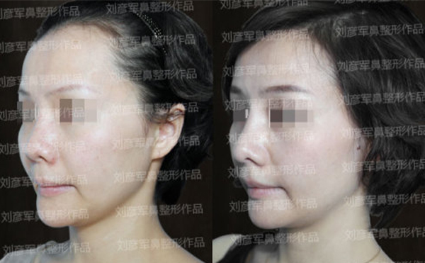 隆鼻失敗的修復費用是多少?