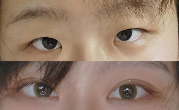小眼癥矯正的具體方式有哪些?術(shù)后會(huì)留疤嗎?