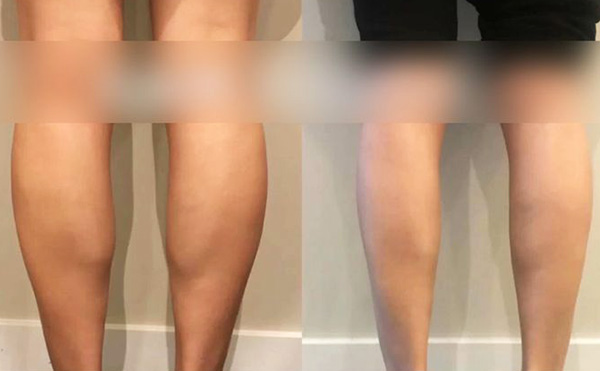 打瘦腿針是怎么操作的？