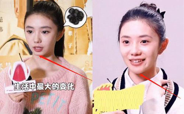 玻尿酸隆下巴整形攻略【優(yōu)勢、適宜人群、注意事項(xiàng)】