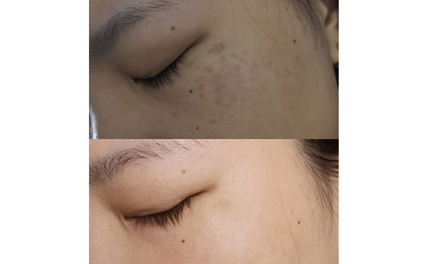 激光美白能維持多久？