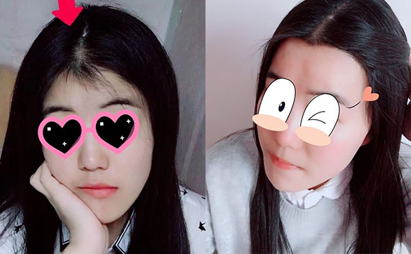 冰點(diǎn)脫毛發(fā)際線怎么樣？