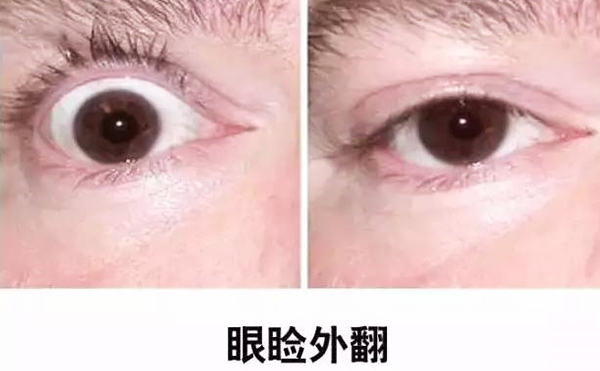 醫(yī)美技術(shù)越來(lái)越發(fā)達(dá)，不少愛(ài)美的人本著變美的心情滿懷期待地去做雙眼皮、開(kāi)眼角等項(xiàng)目，不料整容不成、反倒毀容，后悔也來(lái)不及。有些做雙眼皮的姑娘術(shù)后出現(xiàn)眼瞼外翻的情況，那眼瞼外翻是什么意思?上眼瞼外翻如何修復(fù)?