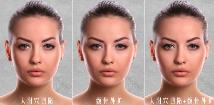 顴弓外擴嚴重