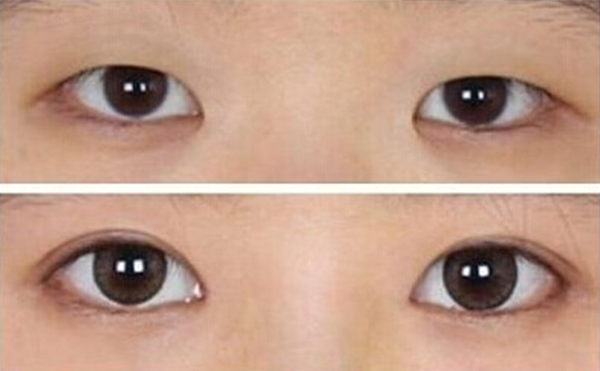 眼球突出矯正術(shù)恢復(fù)時(shí)間需要多久?術(shù)后怎么護(hù)理?