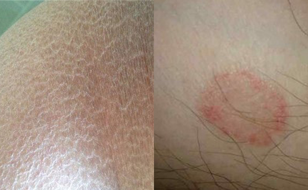 脫腋毛有什么副作用嗎？