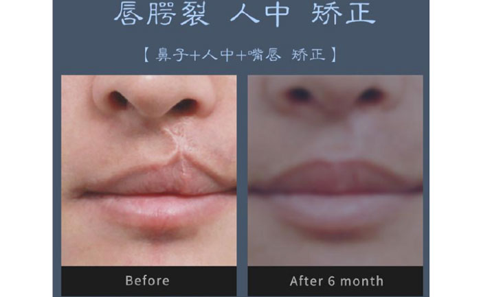 唇裂修復(fù)術(shù)需要多少錢？