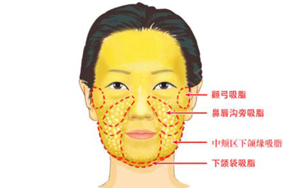 面部吸脂有哪些部位？