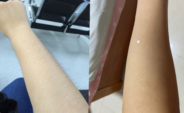 激光手臂脫毛價格貴不貴？