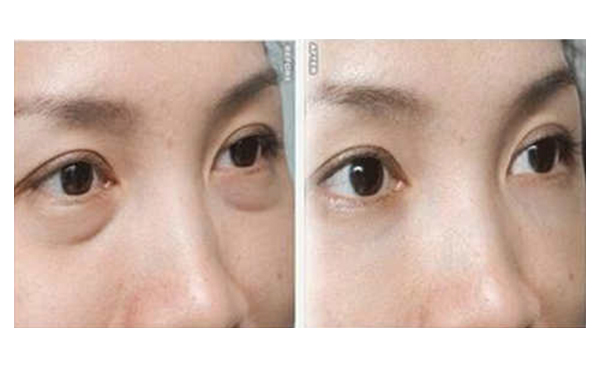 吸脂去眼袋有什么優(yōu)勢(shì)？