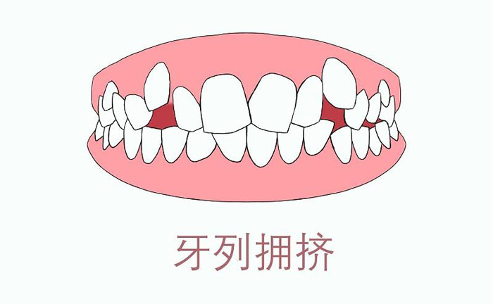 矯正牙齒擁擠度怎么算？