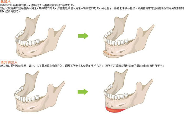 下頜角切除術(shù)一般多少錢？下頜角切除有后遺癥嗎？