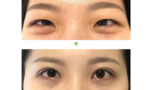 雙眼皮手術的種類及優(yōu)缺點是什么?術后怎么護理效果好?