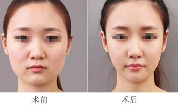 面部吸脂會導致臉下垂嗎？