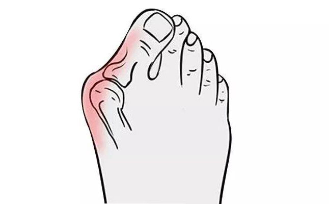 大腳骨矯正手術(shù)多少錢(qián)？大腳骨矯正三個(gè)月可以恢復(fù)嗎？