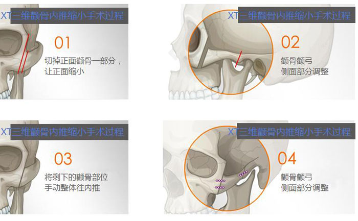 額骨內(nèi)推是什么手術(shù)？