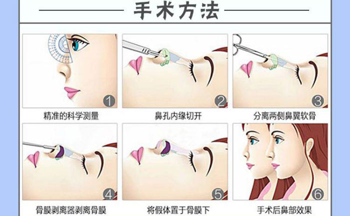隆鼻假體取出后能恢復(fù)到以前嗎？