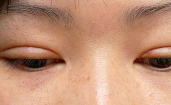 埋線雙眼皮失敗該如何修復(fù)？多久修復(fù)好？