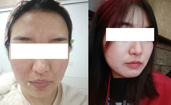 美白針可以維持多久？