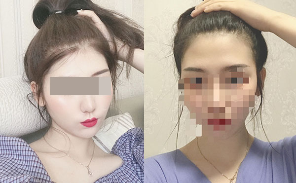 冰點(diǎn)脫毛后多久可以洗澡嗎？