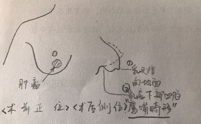 乳房畸形是什么原因造成的？乳房畸形矯正手術(shù)方法？