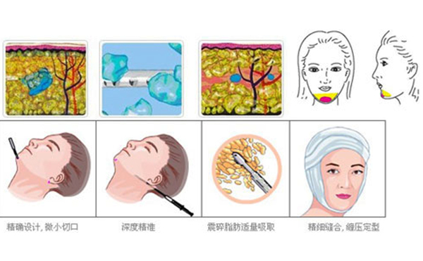 下巴整形吸脂術(shù)要多少錢？