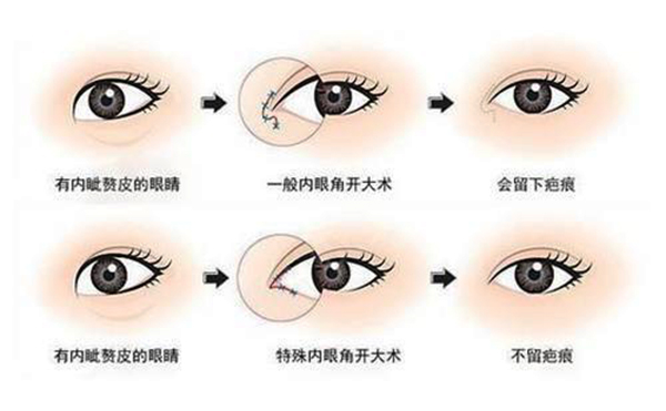 開(kāi)內(nèi)眼角適合哪些人群?開(kāi)內(nèi)眼角會(huì)留疤嗎?