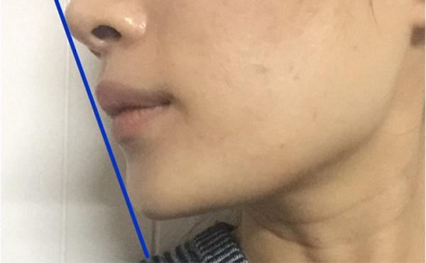 做假體墊下巴恢復(fù)后會被摸出來做過嗎？還能打玻尿酸嗎？