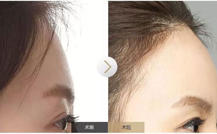 額頭填充術(shù)可以保持多久？