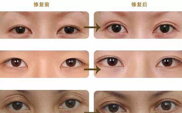 雙眼皮修復(fù)可靠嗎？什么時(shí)候做雙眼皮修復(fù)比較好？