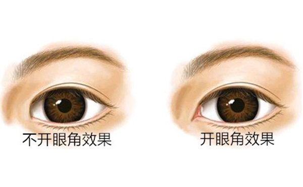 開(kāi)內(nèi)眼角價(jià)格是多少?開(kāi)內(nèi)眼角多久能恢復(fù)好?