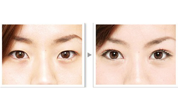 雙眼皮手術的種類及優(yōu)缺點是什么?術后怎么護理效果好?