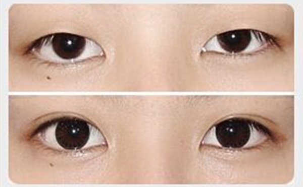 割雙眼皮和開眼角可以同時進(jìn)行嗎?一共多少錢?